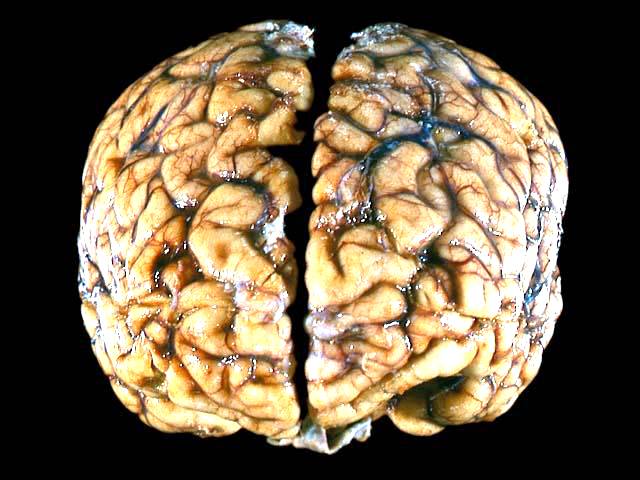 Brain disease. Человеческий мозг живой.