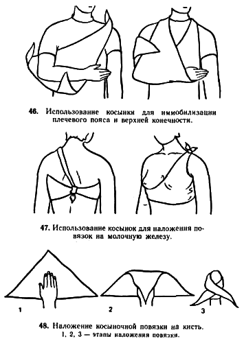 Косыночная повязка на верхнюю конечность алгоритм. Перелом плеча Косыночная повязка. Косыночные повязки алгоритм наложения. Косыночная повязка на плечевой сустав алгоритм.