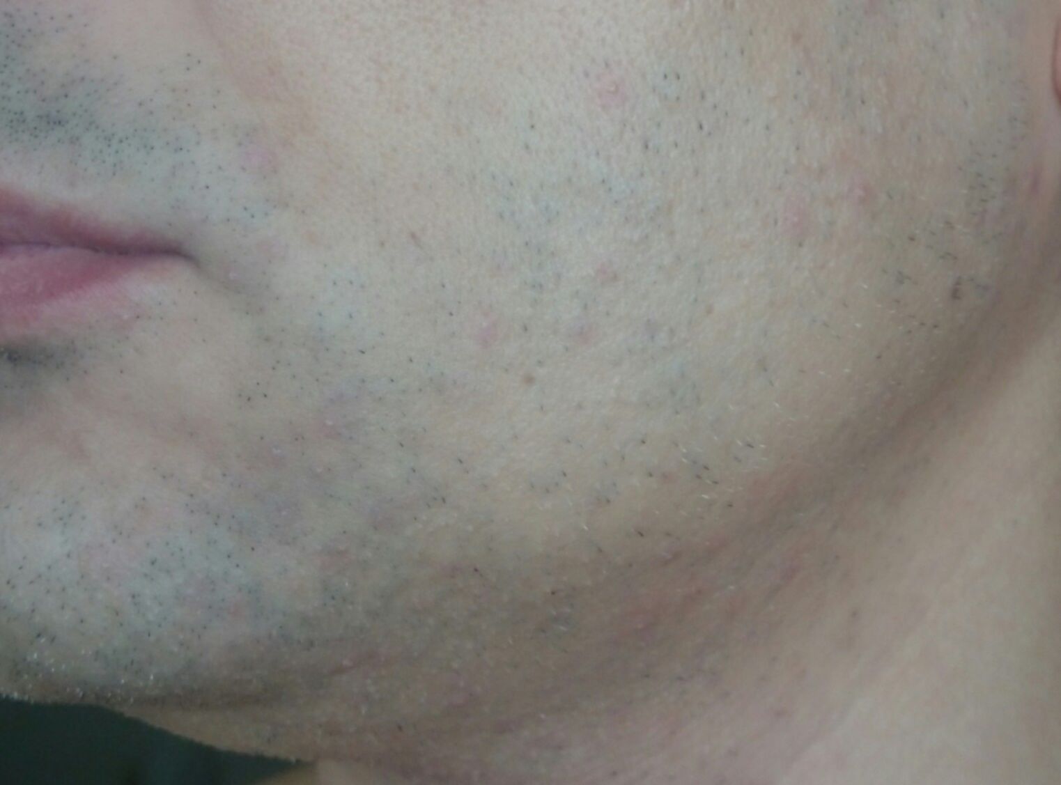 Синева над губой от бритья