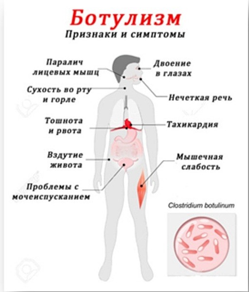 В клинической картине ботулизма обычно не наблюдается